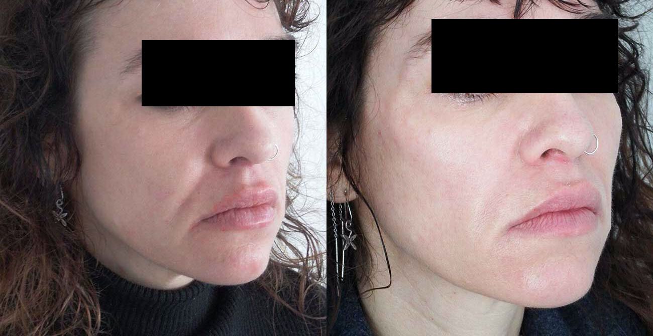 Dermal filler used to lift cheeks, under eye area, nasolabial folds, mouth and eyes and to tighten jawline – right side.