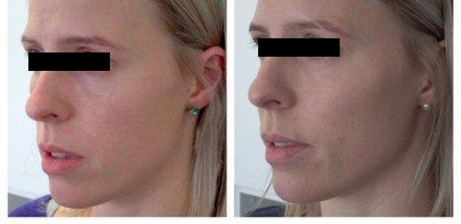 Before and after dermal filler to cheeks, temples and lips