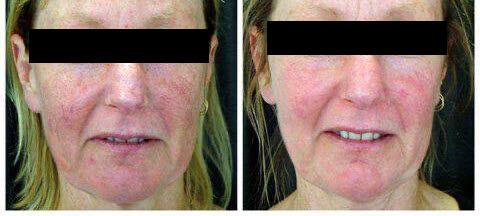Severe rosacea vastly improved with ELOS IPL.