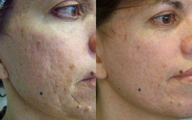 Severe acne scarring dramatically improved by Fraxel Dual Laser.