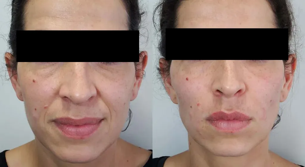 The liquid facelift with dermal fillers