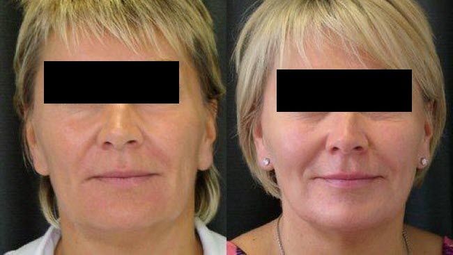 Before and after dermal fillers