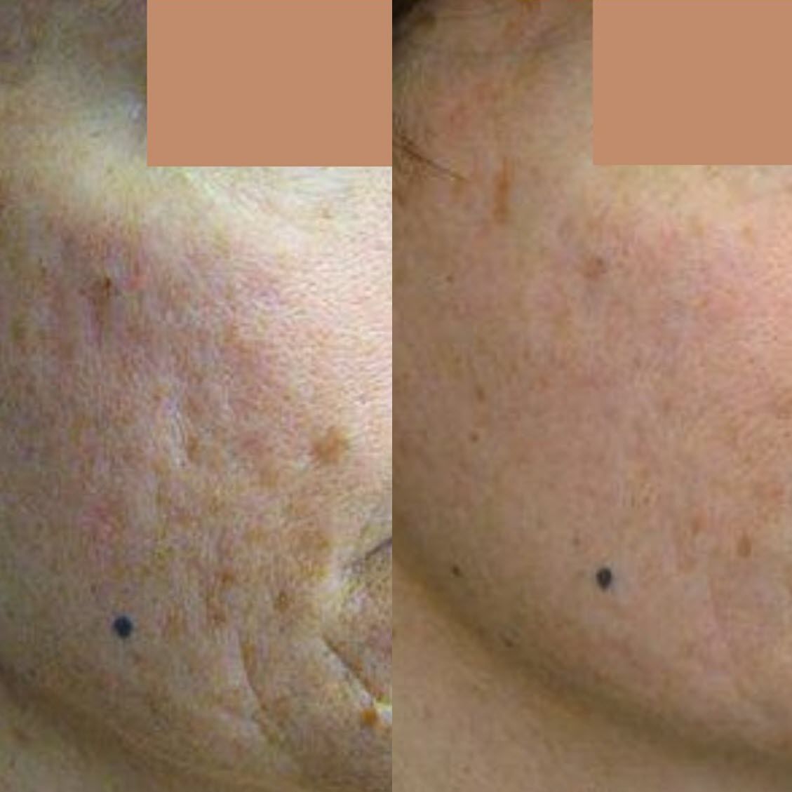 Acne Scarring