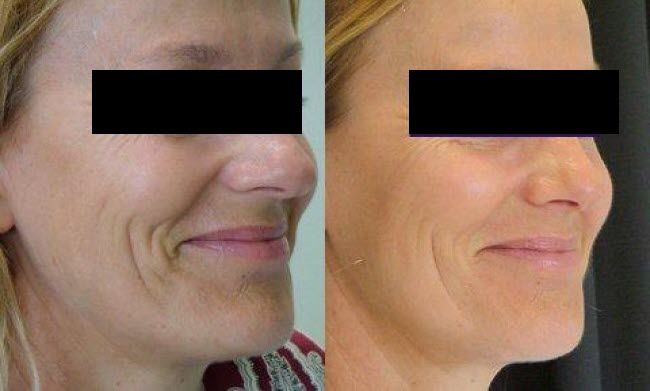 Before and after dermal fillers