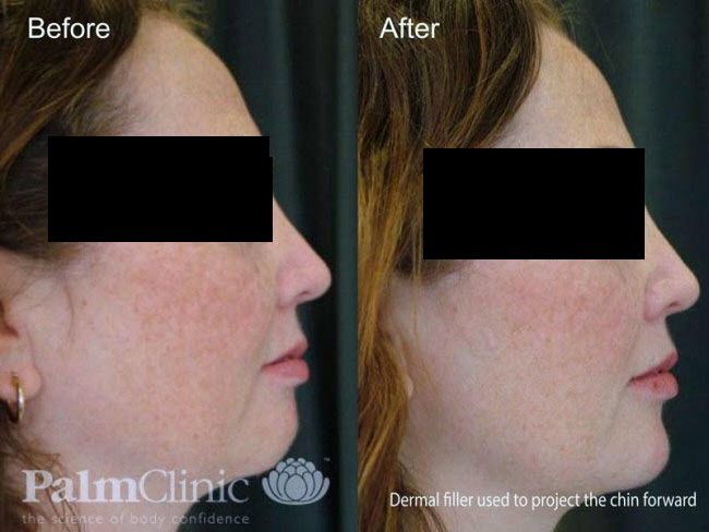 Before and after dermal fillers