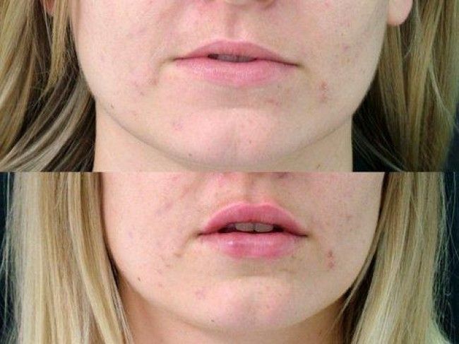 Dermal Lip Fillers before and after at Palm Clinic.