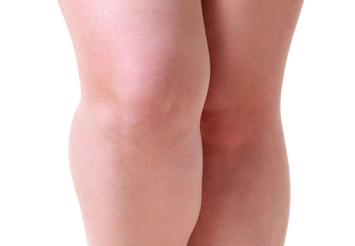 Female liposuction knees