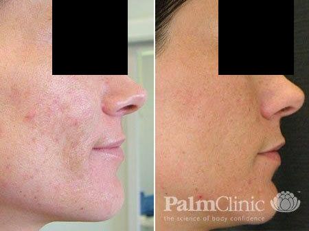 Melasma and acne scarring treated with Fraxel Laser*