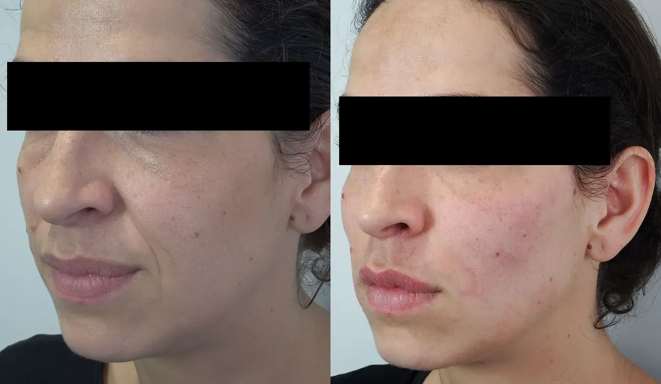 Dermal Fillers in the temples, cheeks and nasolabial folds achieves an impressive lift.