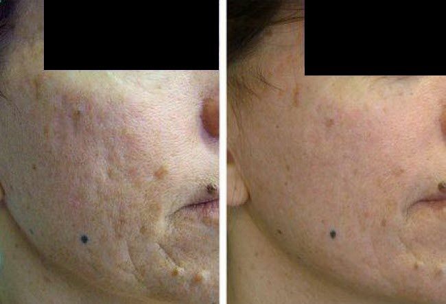 Severe acne scarring dramatically improved by Fraxel Dual Laser.