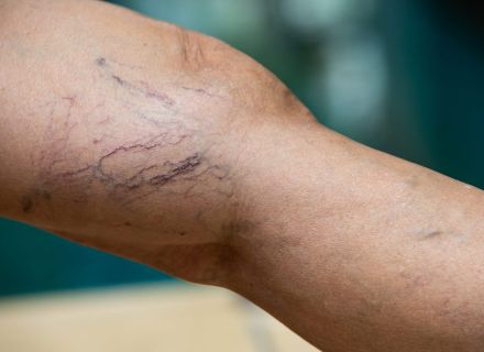 Before and after spider vein treatment