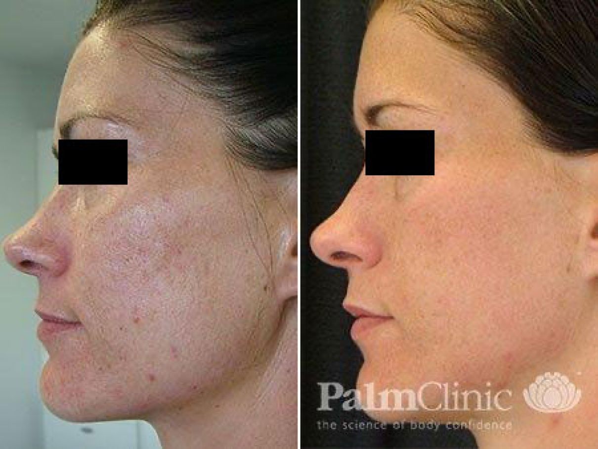 Fraxel Dual Laser has been used to treat acne scarring.