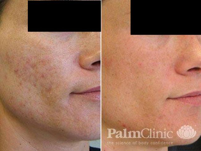 Fraxel Laser has significantly improved acne scarring.