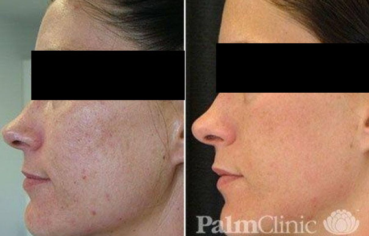 Fraxel Dual Laser has been used to treat acne scarring.