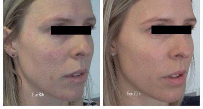 Before and after dermal fillers