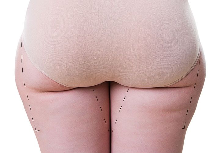 Female liposuction thighs