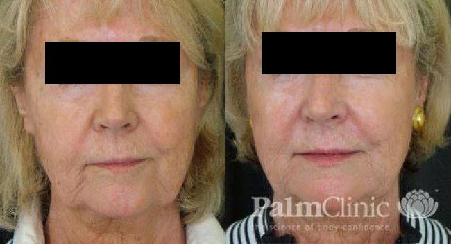 Before and after dermal fillers