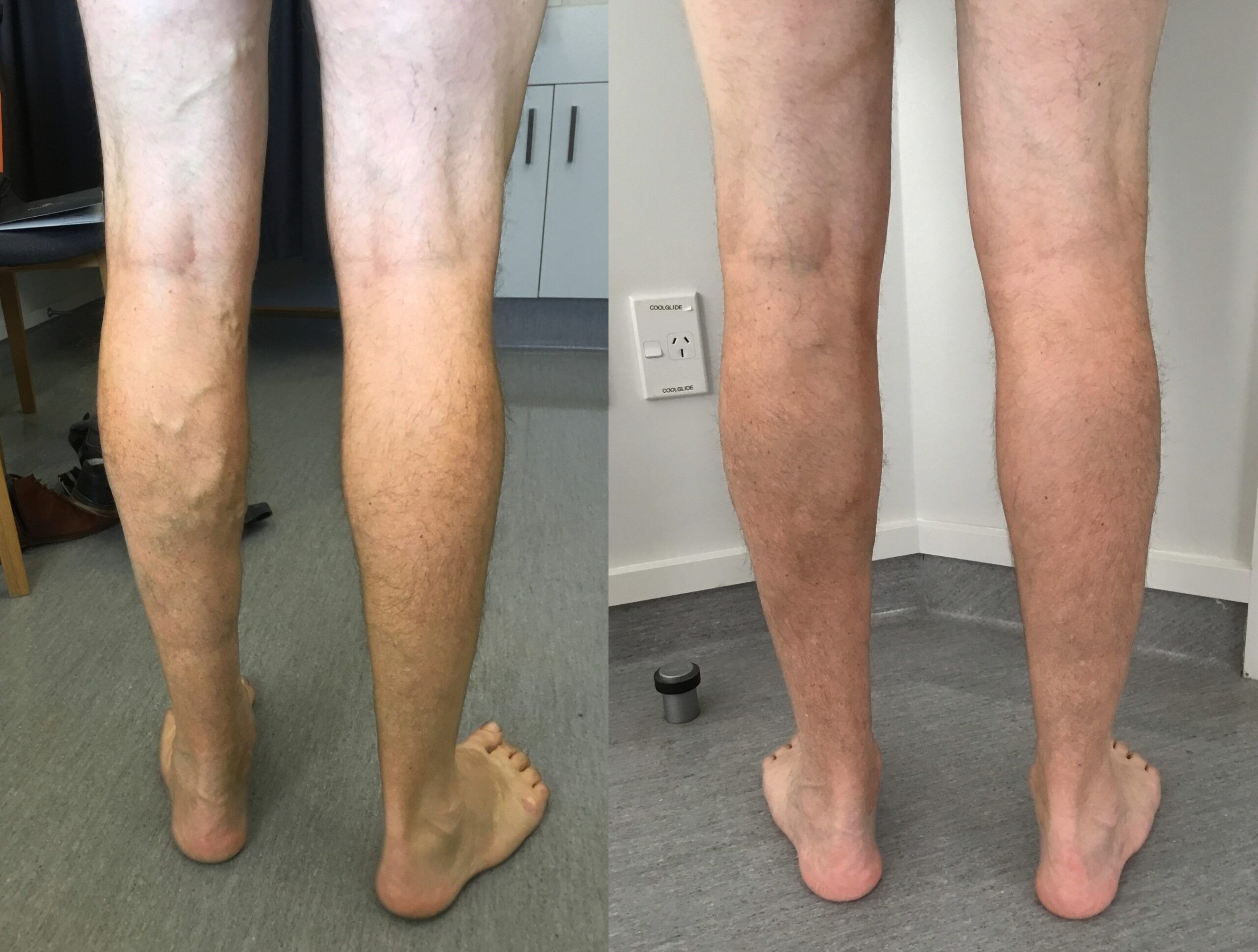 Varicose veins before and after treatment at Palm Clinic