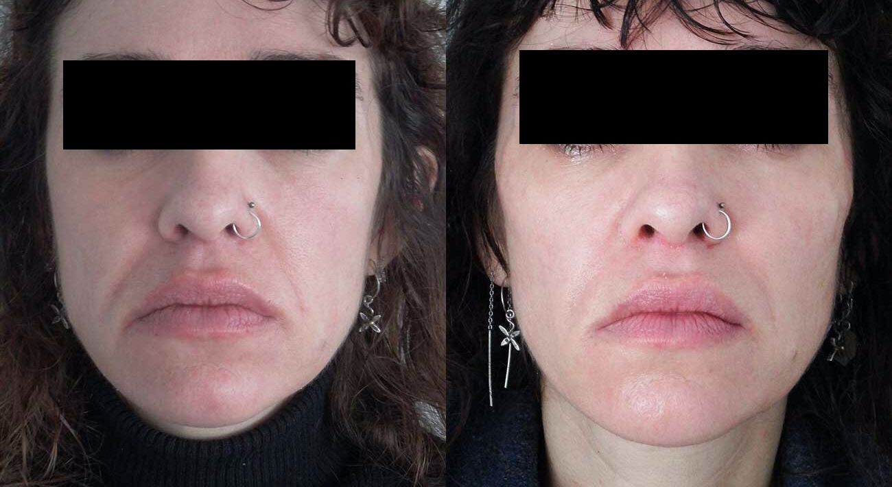 Dermal filler used to lift cheeks, under eye area, nasolabial folds, mouth and eyes and to tighten jawline – front.