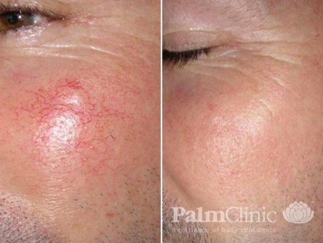 Facial redness is often associated with rosacea.