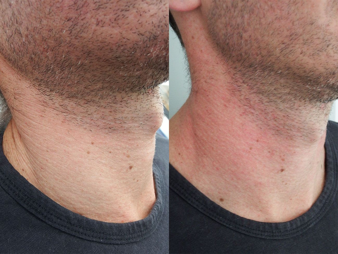 Significant improvement in texture of skin on neck using dermal filler