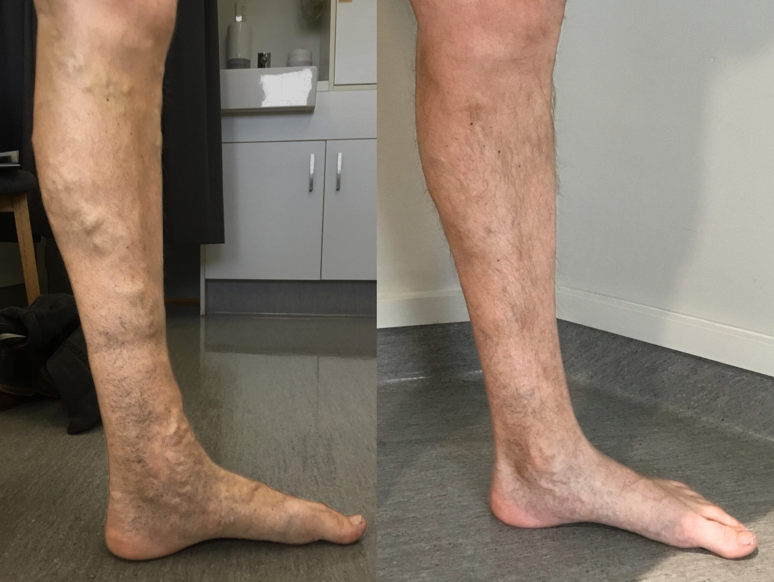 Varicose veins before and after treatment at Palm Clinic