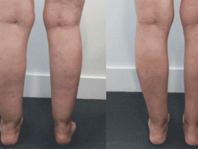 Female liposuction calves