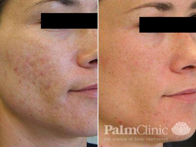 Fraxel Laser has significantly improved acne scarring.