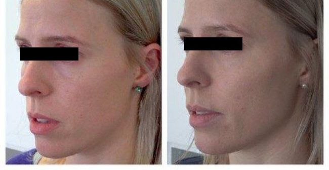 Before and after dermal fillers