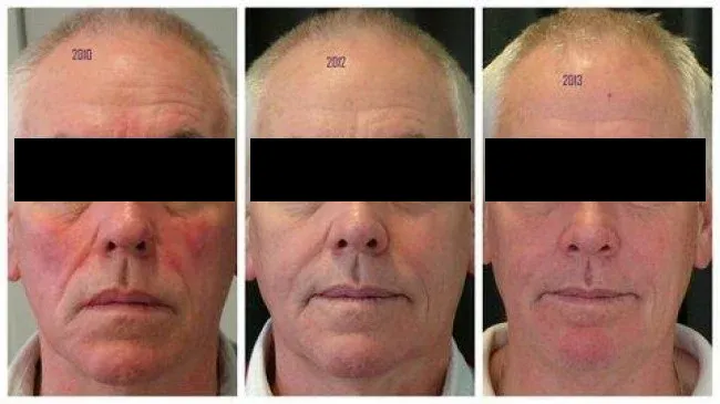 Dermal fillers reverse ageing