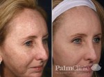 Before and after Fraxel Dual laser for sun damaged face