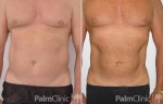 Before and after male chest and abdomen liposculpture