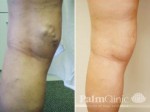 Before and after image of varicose veins treated with EVLA