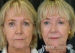 Before and after dermal fillers