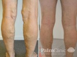 Is surgery necessary for varicose veins?