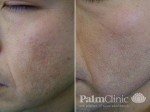 Acne Scars and Fraxel Laser