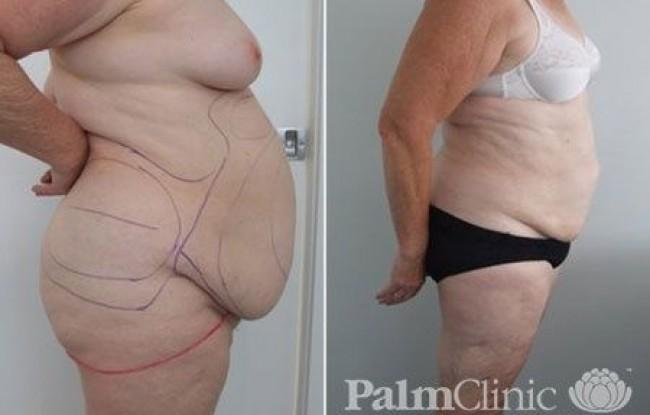 Abdomen overhang before and after Liposuction