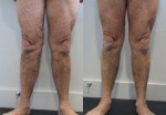 Varicose Veins treated with Laser