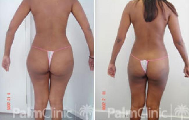 Tumescent Liposuction before and after photos