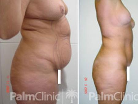Abdomen and hips before and after liposculpture