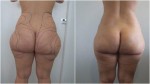Buttocks and Outer Thighs Before and After Liposculpture