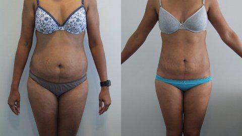 Liposculpture to Abdomen with Stretchmarks - Palm Clinic