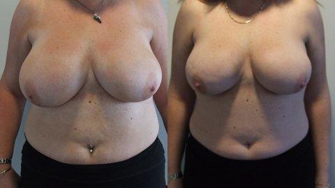 Breast Reduction Post Baby 14G to 14DD