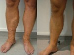 Varicose Veins treated with Laser & UGS