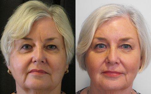 Botox® and Filler for Stubborn Frownline
