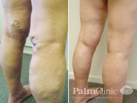 Over 2800 Laser Treatments for Varicose Veins