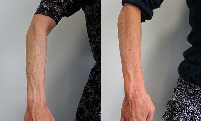 Bulging Arm And Hand Veins: Causes And Treatments - Palm Clinic