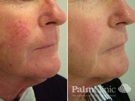 spider veins on face treatment at home