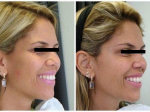 Before and after Botox® used on crows feet
