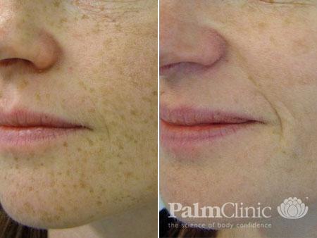 Before and after pigmentation photos